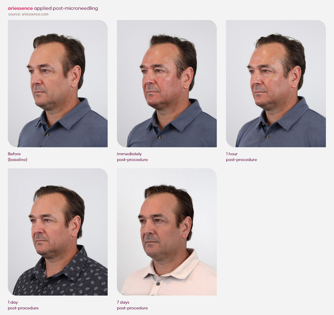 Ariessence applied post microneedling rapid recovery results before and after