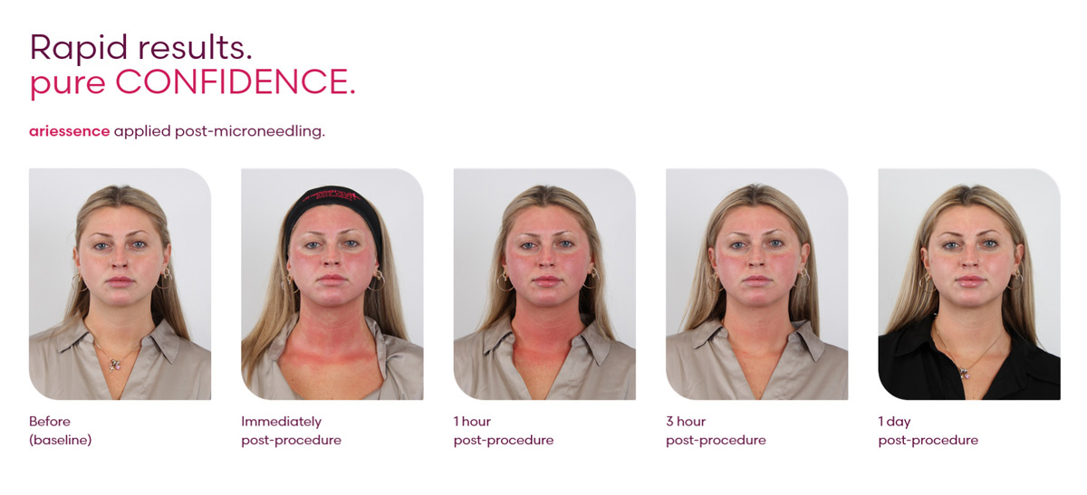 Ariessence applied post microneedling rapid recovery results before and after