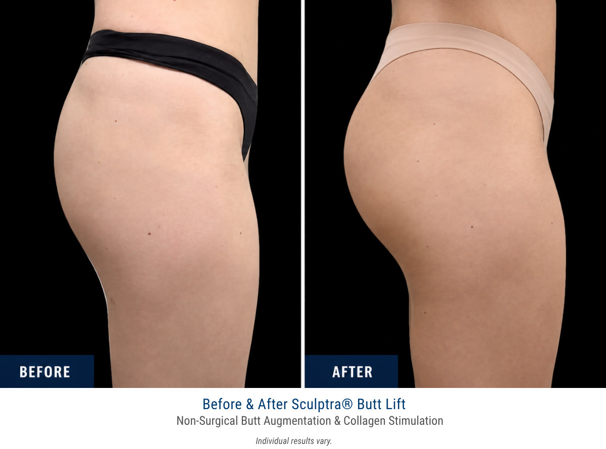 Sculptra Butt Lift Before and After — Non-Surgical Butt Augmentation at Vanity Medical Spa Paramus NJ
