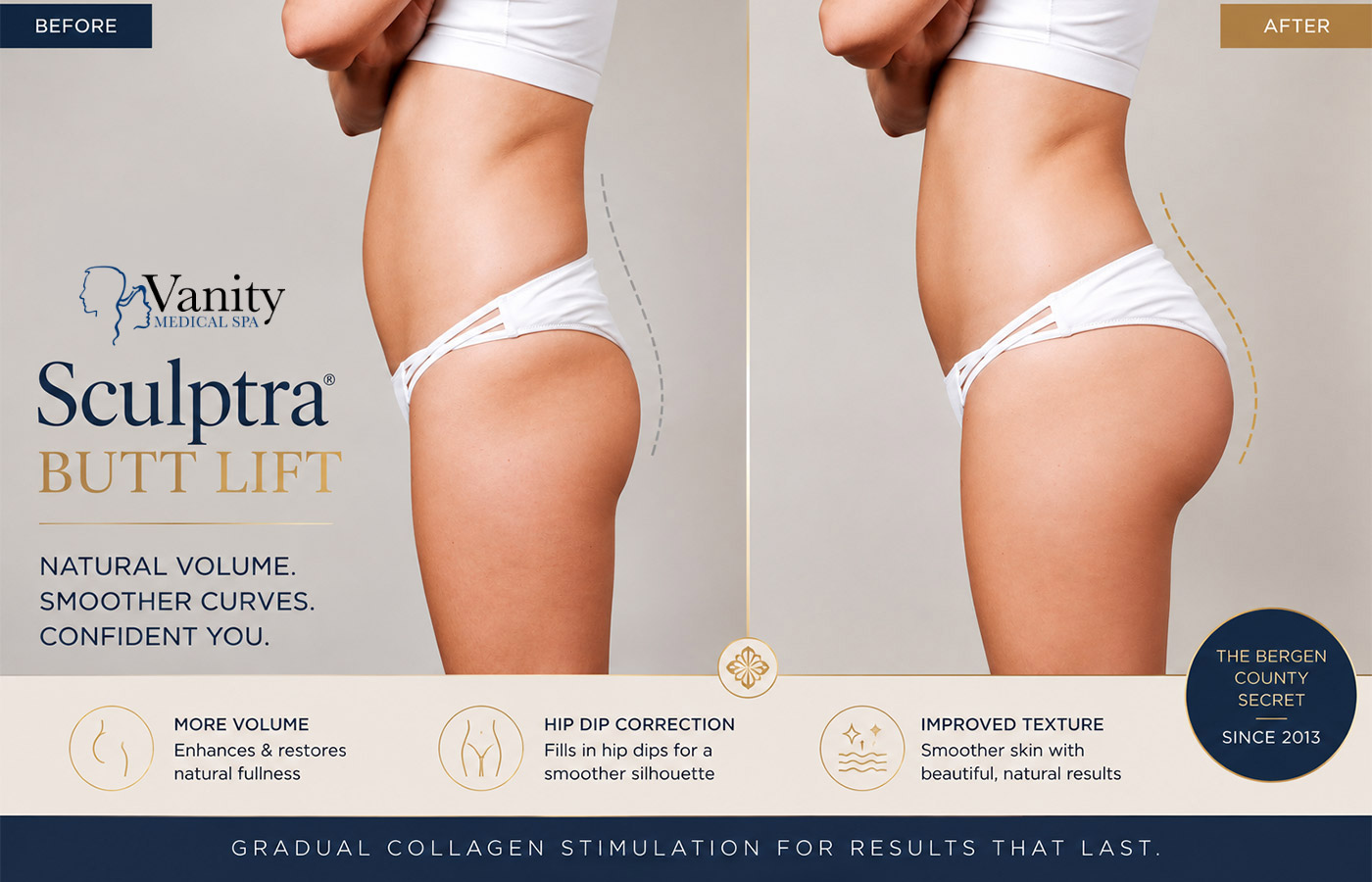 Sculptra Butt Lift Natural Volume Hip Dip Correction — Vanity Medical Spa Bergen County NJ